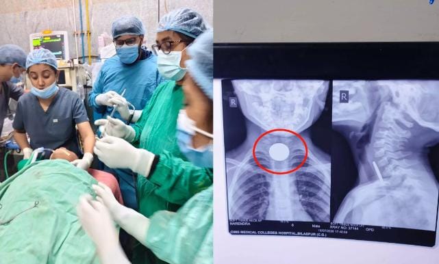 6 साल के मासूम के गले में फंसा सिक्का, डॉक्टरों ने जटिल ऑपरेशन कर बचाई जान